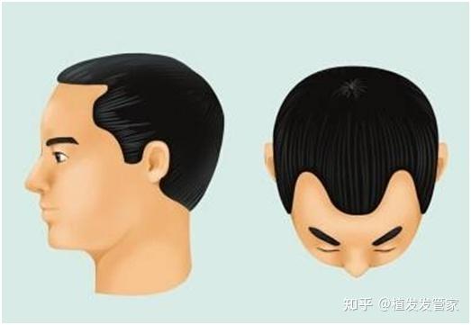 发型屋免费在线发型设计软件_M型脱发_M型脱发治疗