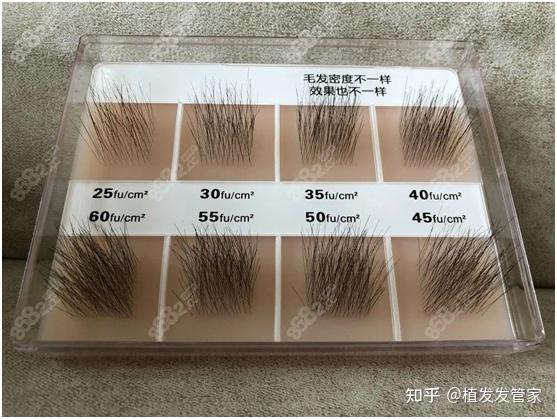 M型脱发治疗_发型屋免费在线发型设计软件_M型脱发